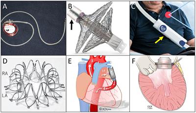 Novel approaches for left atrial pressure relief: Device-based monitoring and management in heart failure